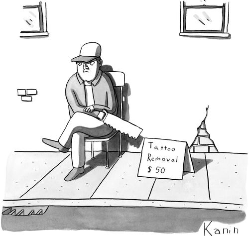 Tattoo Removal