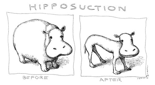 Hipposuction