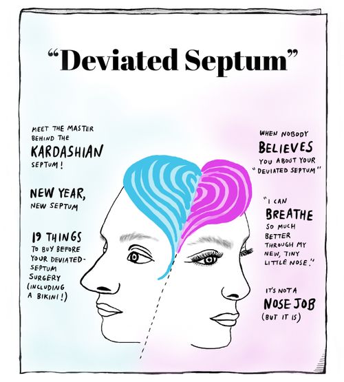 Deviated Septum