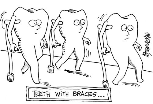Teeth with Braces.