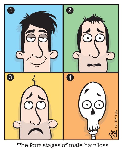 The four stages of male hair loss.