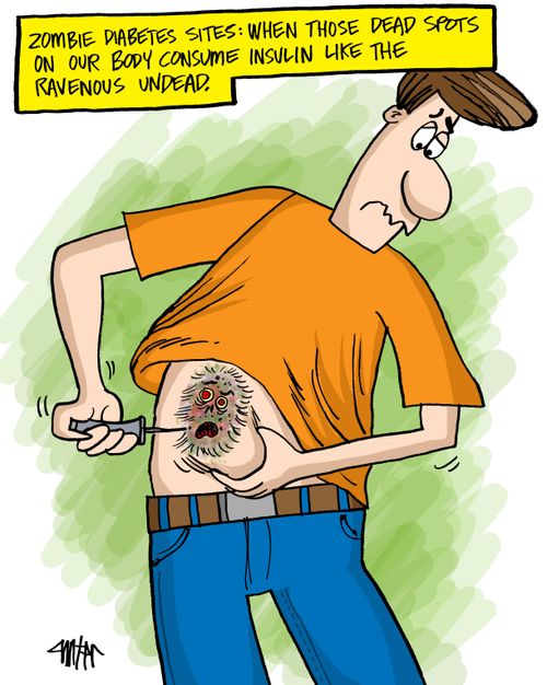 Zombie diabetes sites: When those dead spots on our body consume insulin like the ravenous undead.