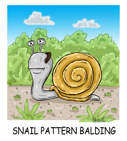 Snail Pattern Balding. 