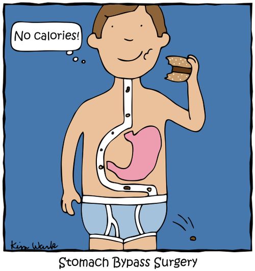 Stomach Bypass Surgery