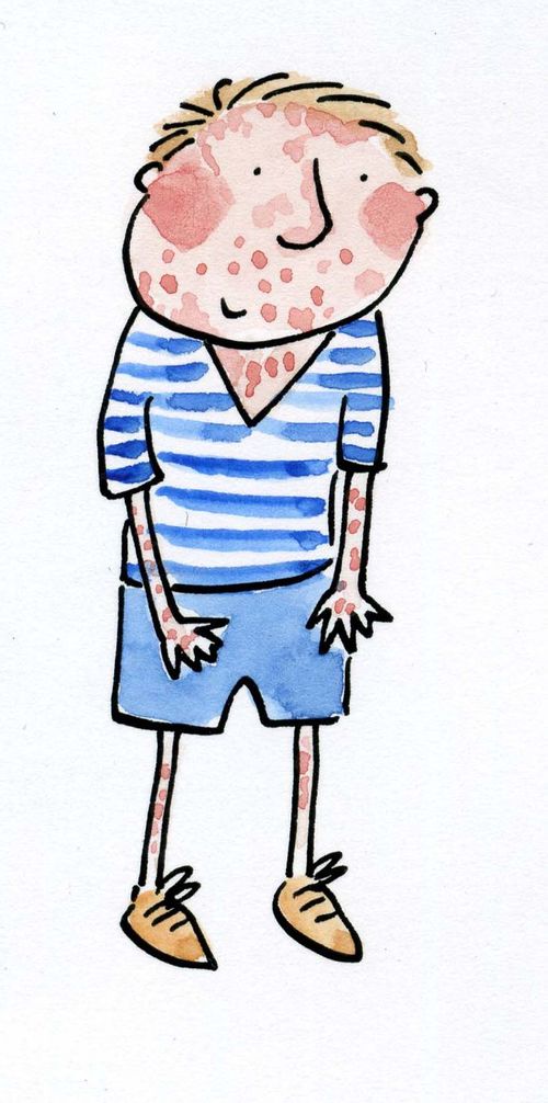 Measles,